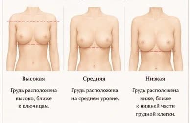 Посадка на грудной клетке: высокая, средняя, низкая