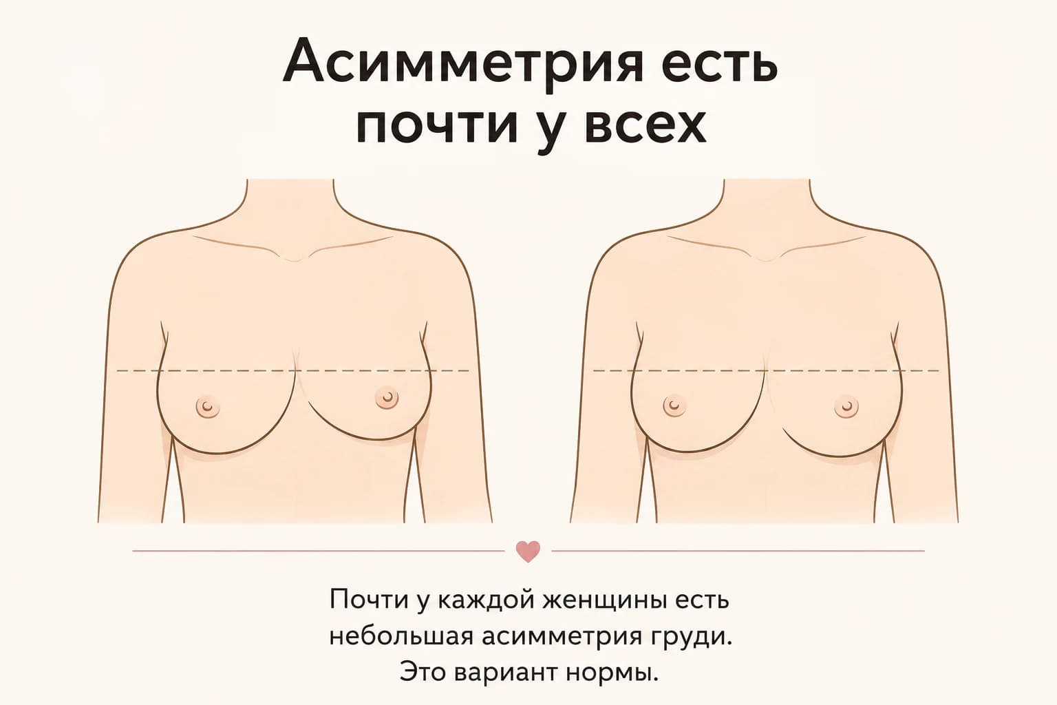 Асимметрия есть почти у всех: две груди с небольшой разницей — это вариант нормы