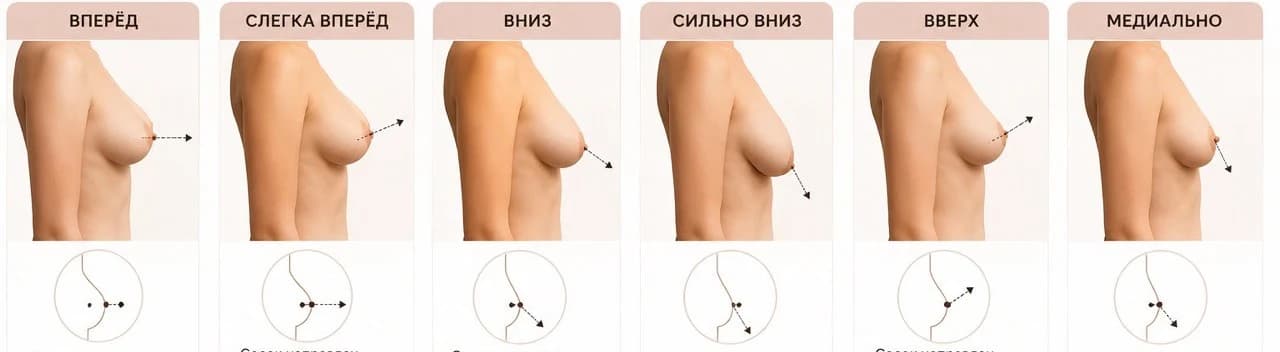 Направление груди: вперёд, слегка вперёд, вниз, сильно вниз, вверх, медиально