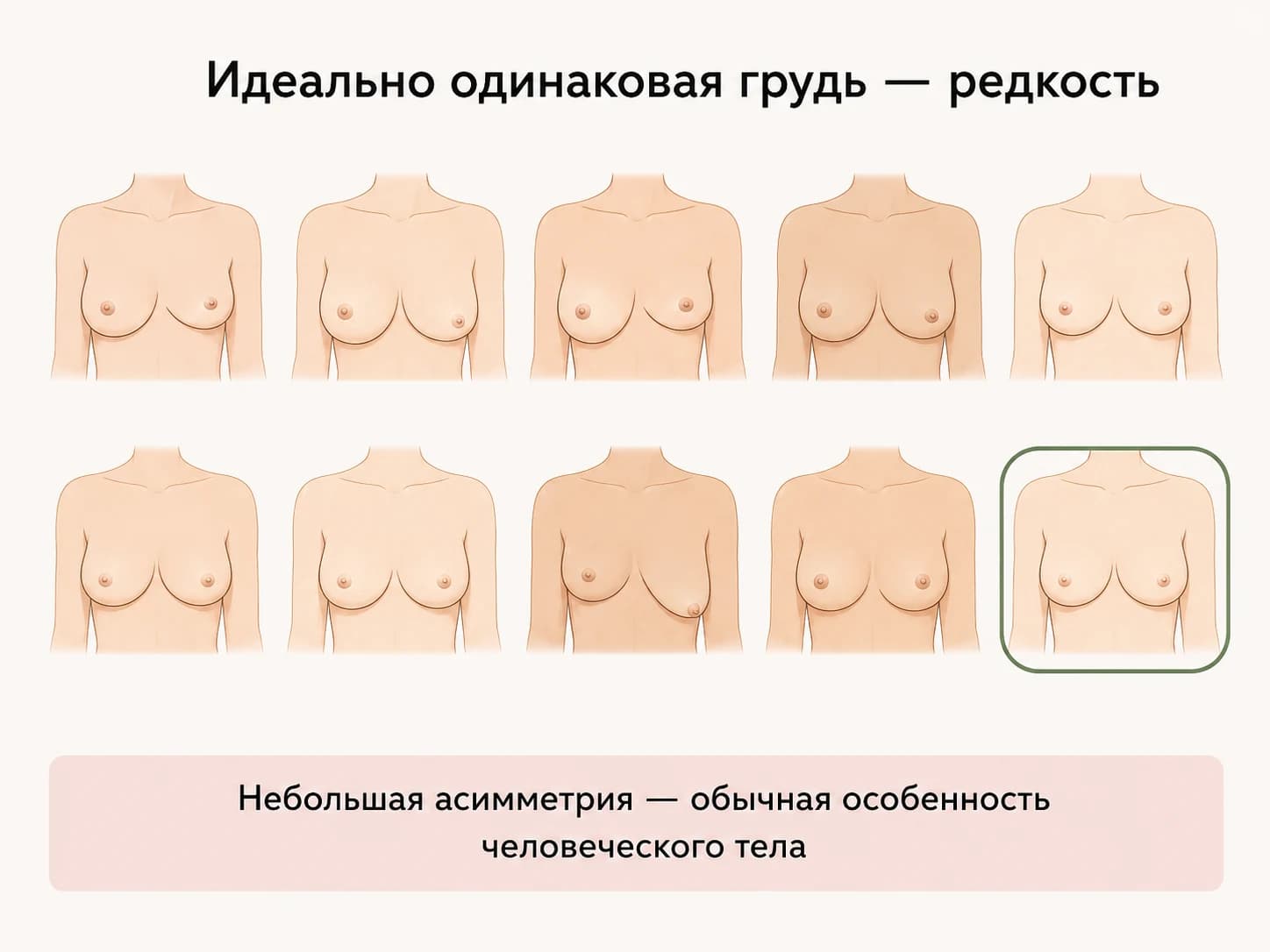 Идеально одинаковая грудь — редкость: небольшая асимметрия это обычная особенность человеческого тела